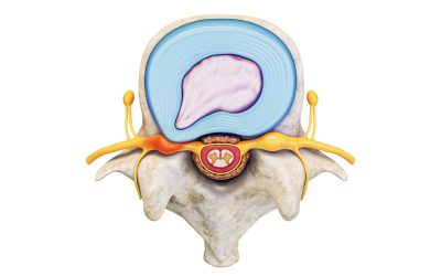 Symptoms and Treatment of Back Pain