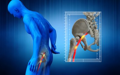 What causes sciatica?