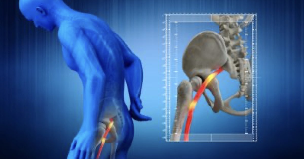 Causes of Sciatica | Buffalo PT