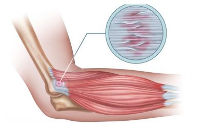 Physical Therapy for Tendinitis