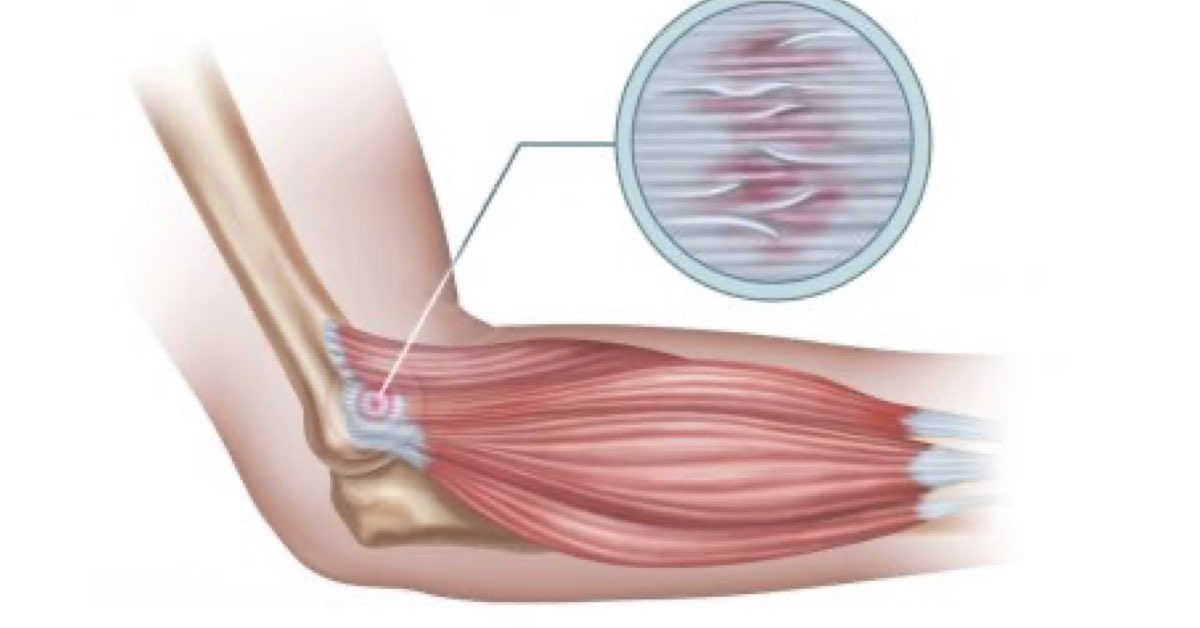 Physical Therapy for Tendinitis