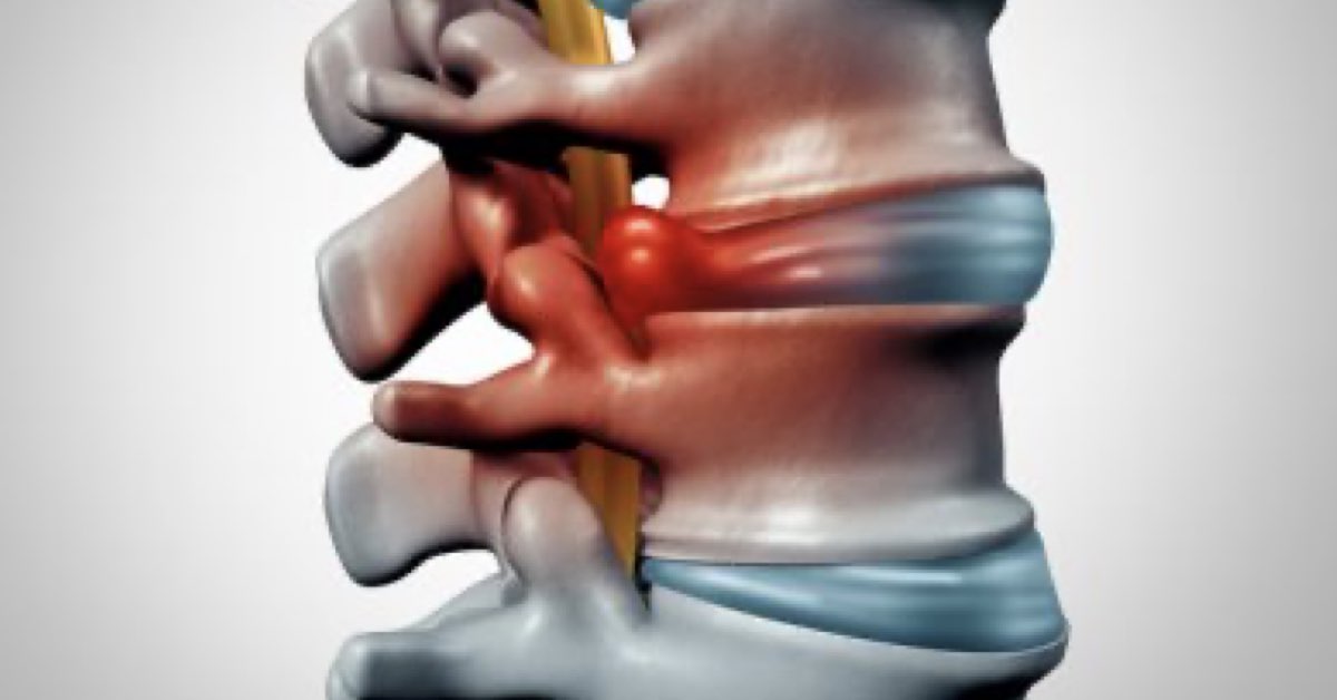 Lumbar Disc Herniation | Neck PT