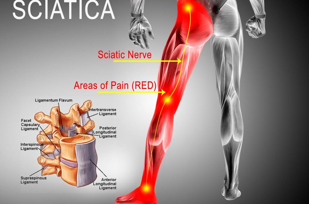 Physical Therapy for Sciatica.  How is sciatica diagnosed?