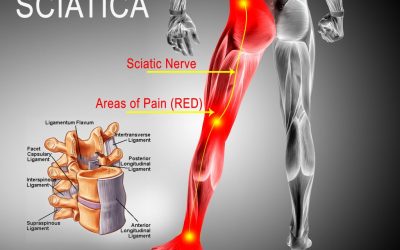 Physical Therapy for Sciatica.  How is sciatica diagnosed?