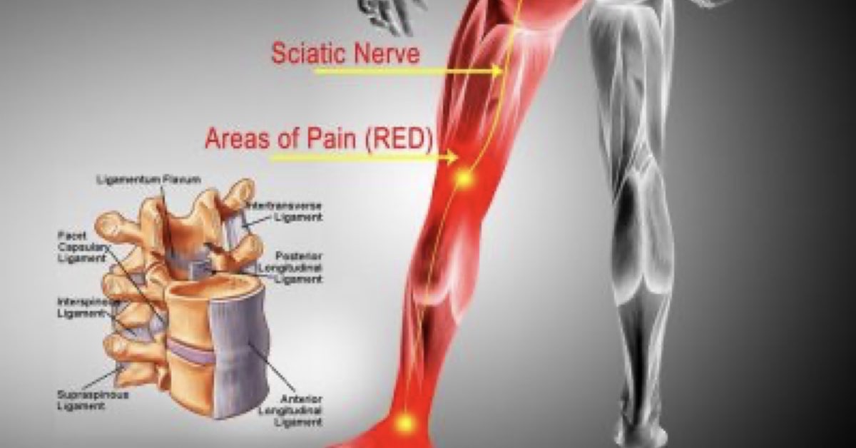 Physical Therapy for Sciatica. How is sciatica diagnosed?