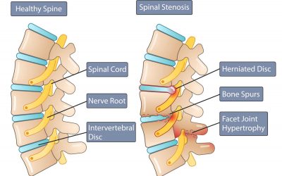 Physical Therapy for Spinal Stenosis Series (Part 1)