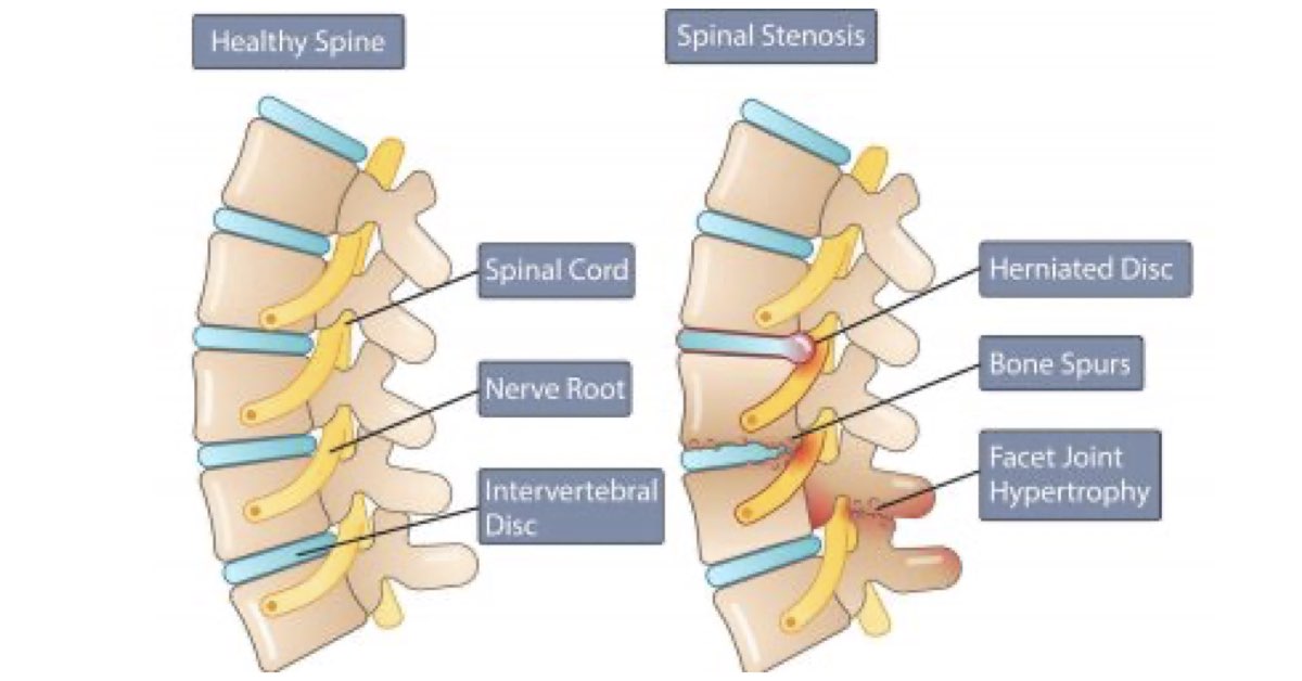 Physical Therapy for Spinal Stenosis Series (Part 1)