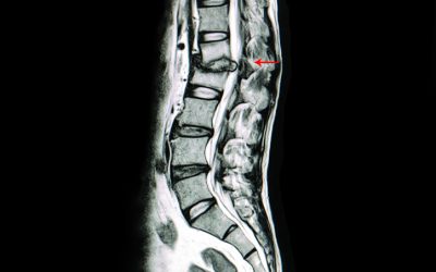I Have a “Slipped Disc”. What is a Disc Herniation?