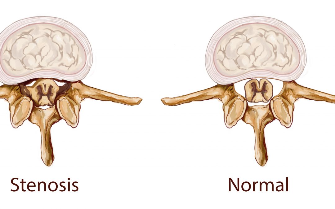 Physical Therapy for Spinal Stenosis Series (Part 3)