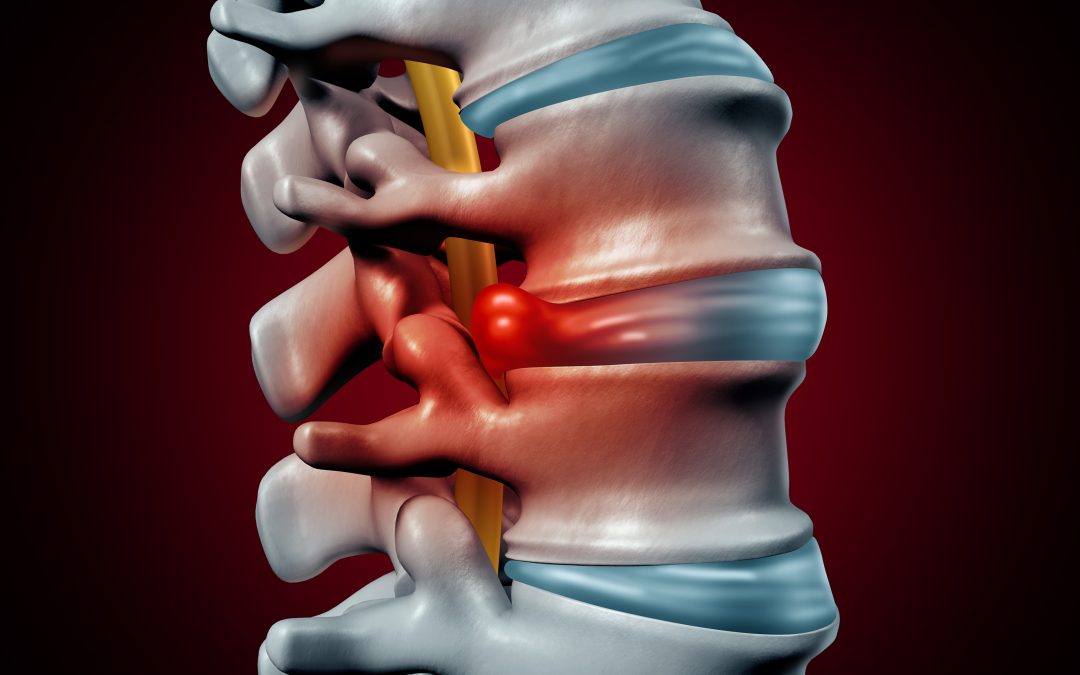 Physical Therapy for Disc Herniations Series (Part 1)