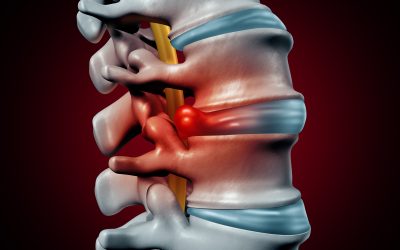 Physical Therapy for Disc Herniations Series (Part 1)