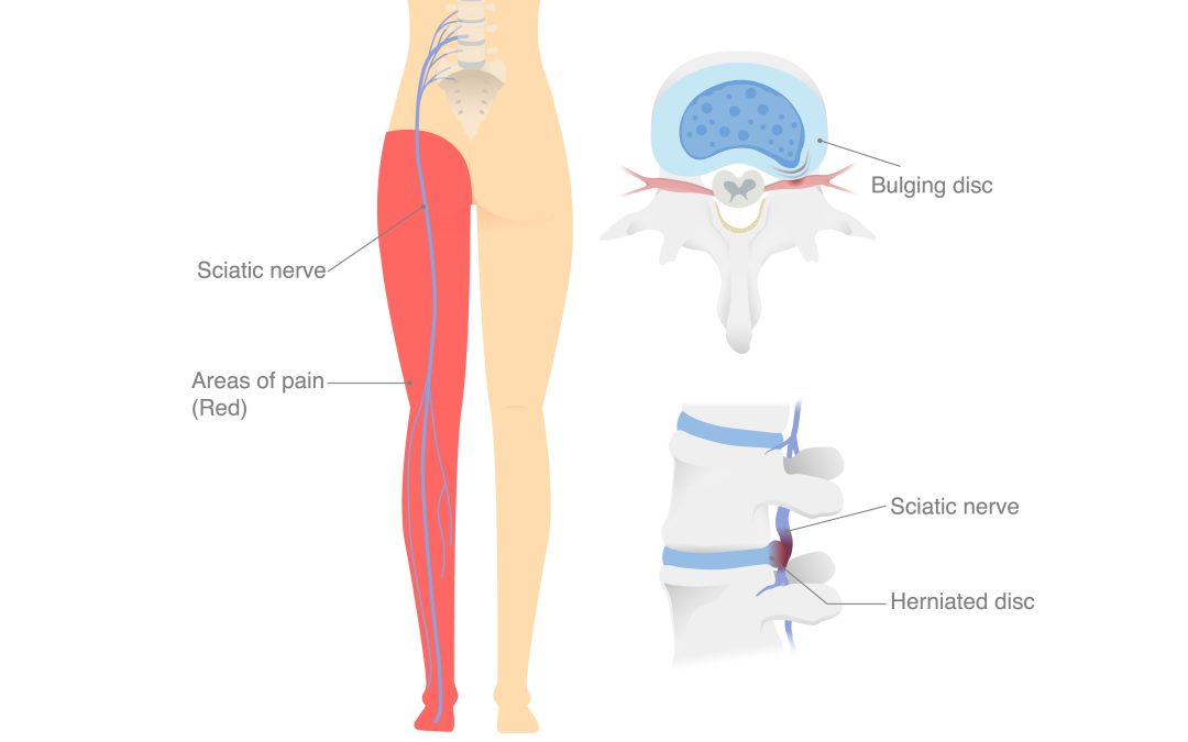 Physical Therapy for Disc Herniations Series (Part 2)