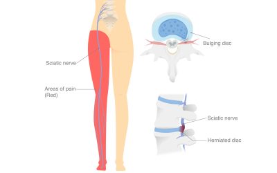 Physical Therapy for Disc Herniations Series (Part 2)