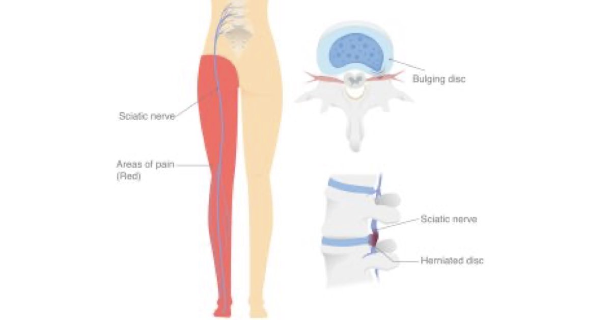 Physical Therapy for Disc Herniations Series (Part 2)