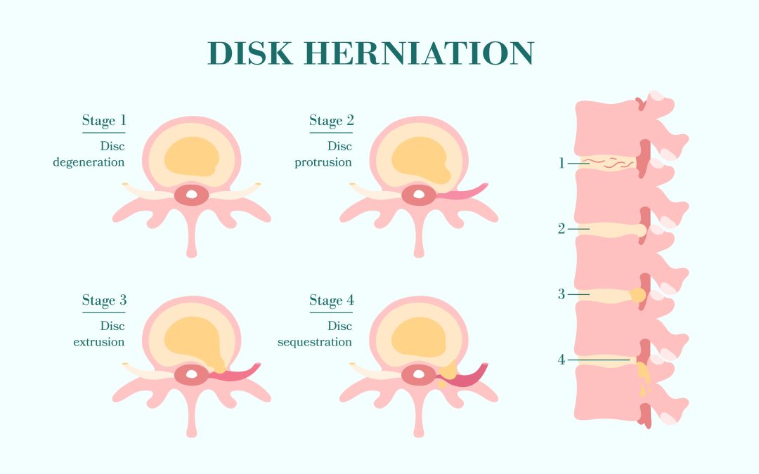 Physical Therapy for Disc Herniations Series (Part 3)