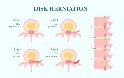 Physical Therapy for Disc Herniations Series (Part 3)