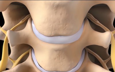 Physical Therapy for Disc Herniations Series (Part 5)
