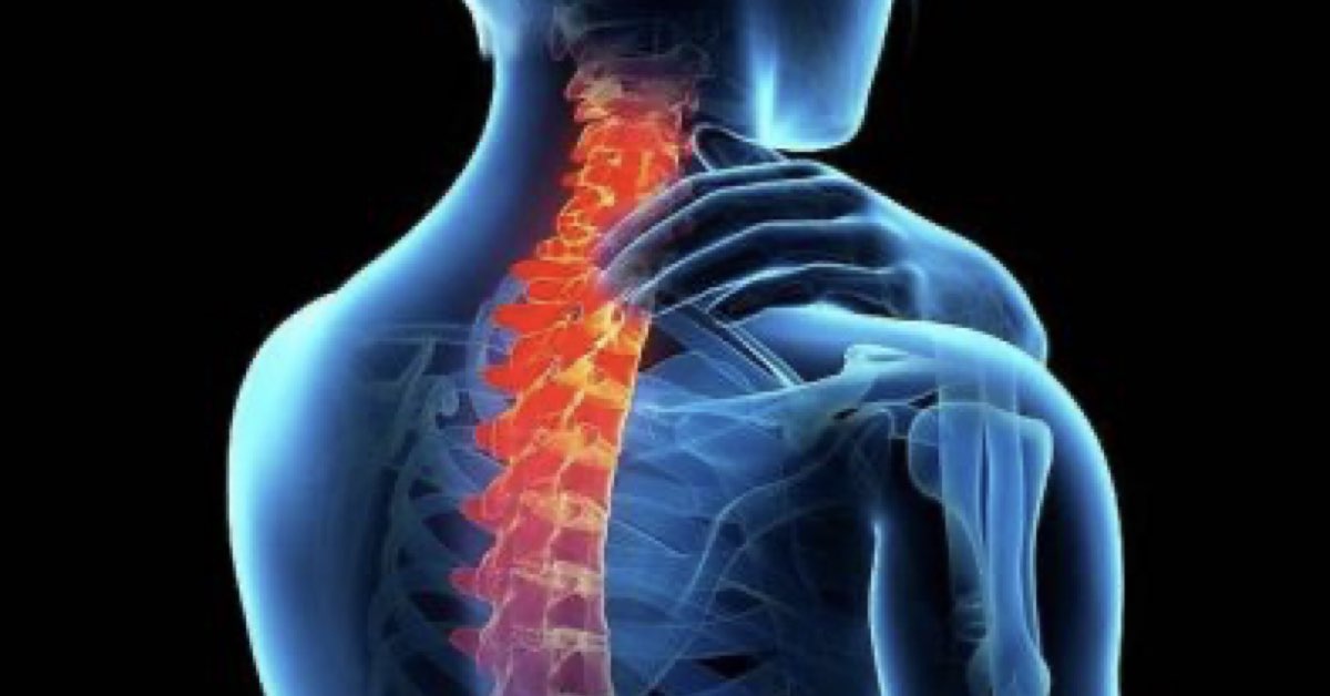 What Causes a Nerve to be Pinched in my Neck