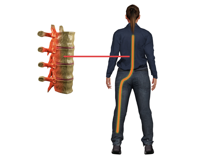 What are some risk factors that contribute to my sciatica?