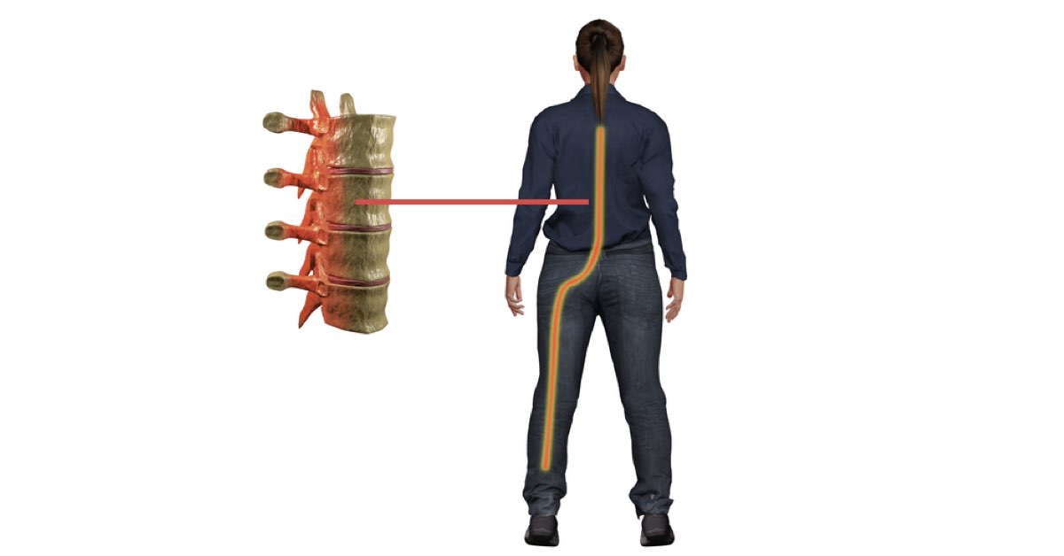 Sciatica Risk Factors