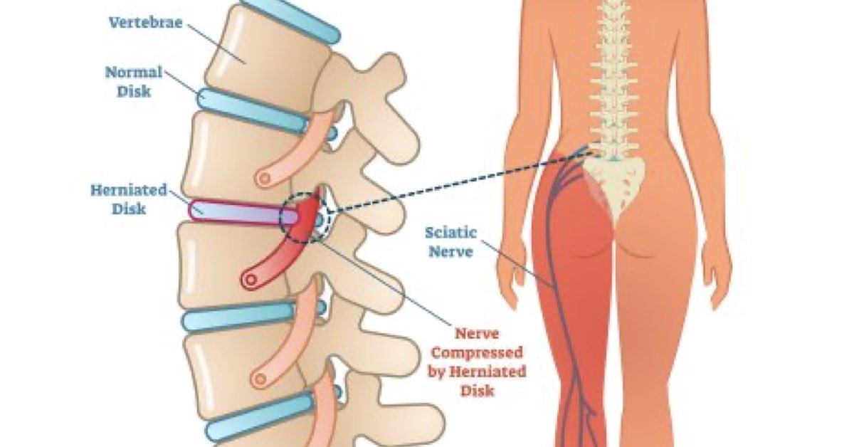 Sciatica Pain | Buffalo Back Neck