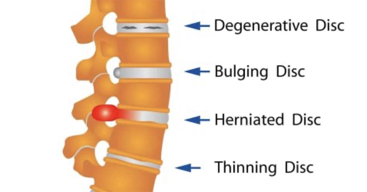 Exercises for Disc Herniations