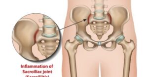 Si Joint Causing Back Pain | Buffalo Back PT