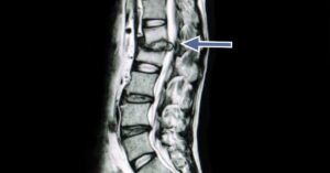Risk Factors for Disc Herniations | Buffalo Back