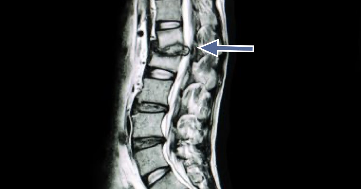 Risk Factors for Disc Herniations | Buffalo Back