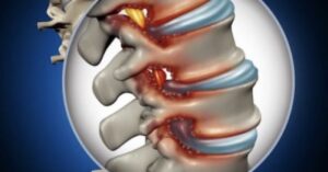 healing disc | Buffalo Back