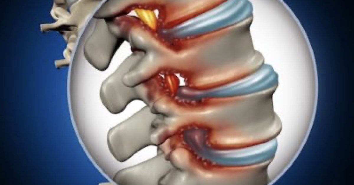 healing disc | Buffalo Back