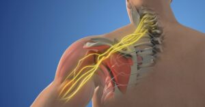 thoracic outlet syndrome