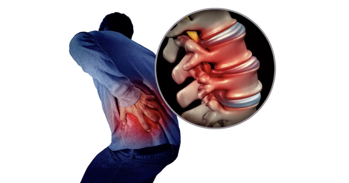 Lumbar Disc Herniations