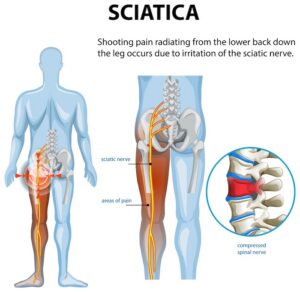 Sciatica Treatments | Buffalo Back & Neck