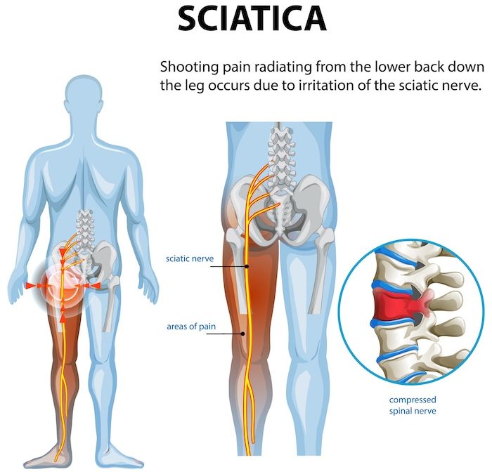 Beyond the Back: Surprising Causes of Sciatica Not Found in the Lumbar Spine