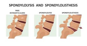 spondylolysis | Buffalo Back and Neck